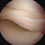 lesione meniscale